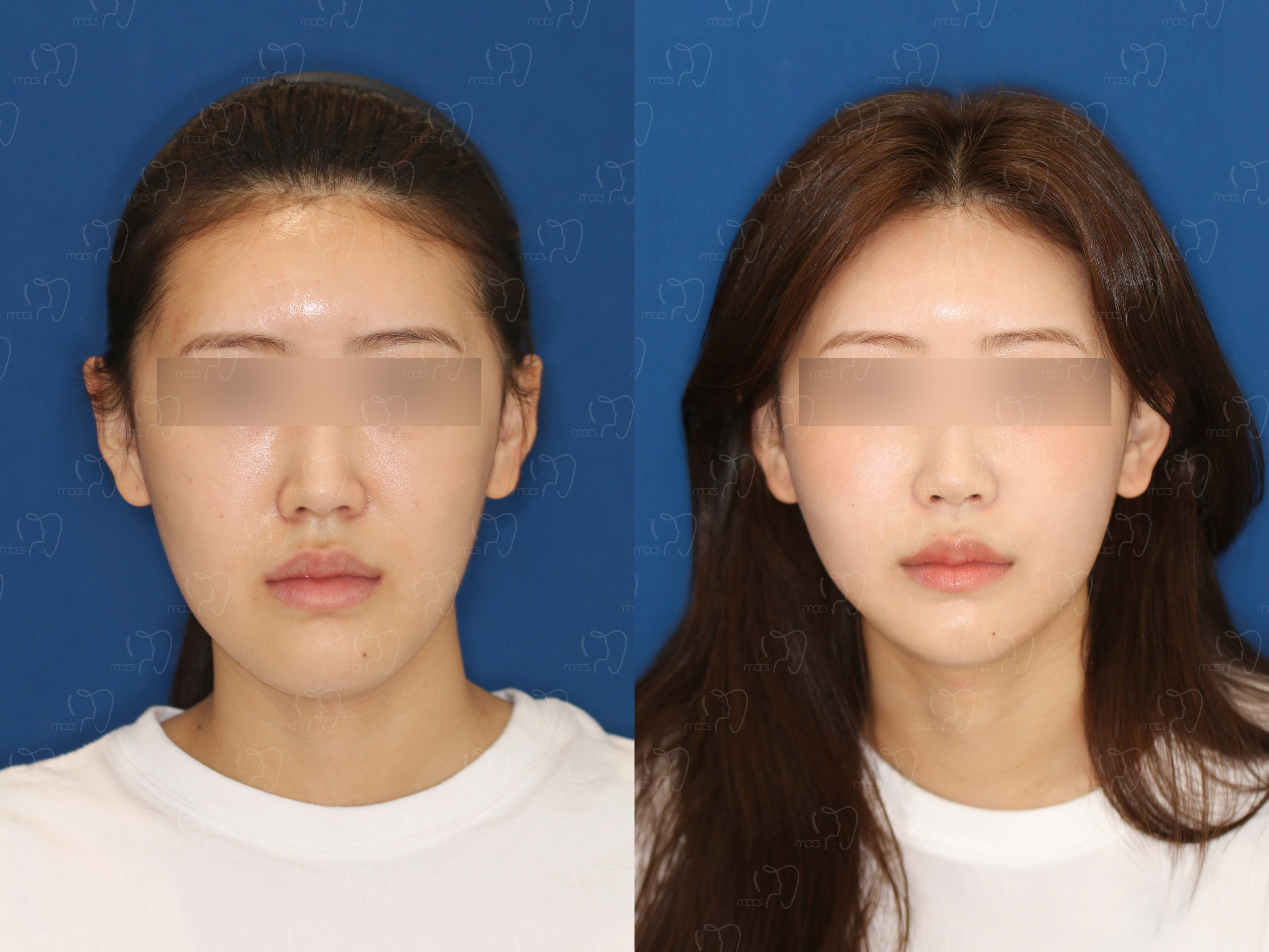 맥스구강악안면외과 수술 전후사진
