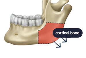MACS Corticectomy