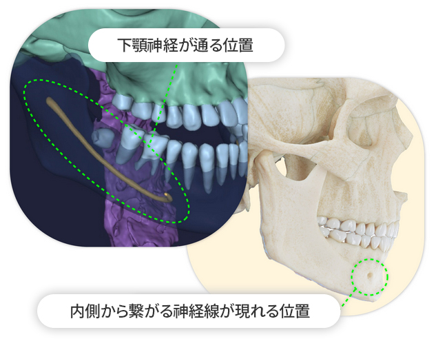 Vライン手術！