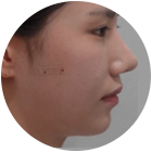 수술 후 옆모습을 수술 전 두 눈으로 확인 가능