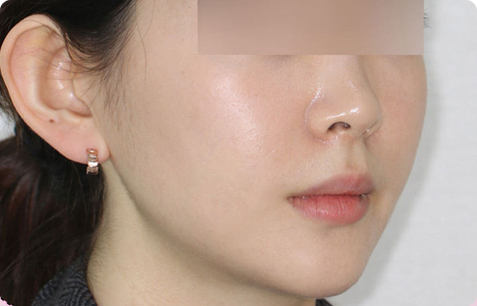 광대축소+사각턱+턱끝 전후사진