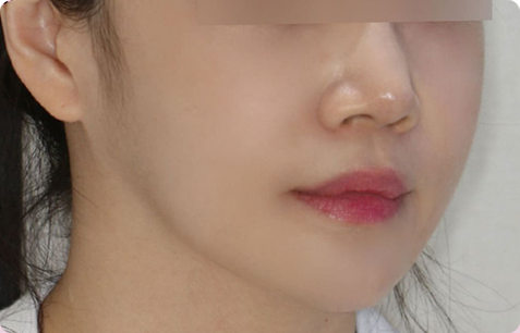 광대축소+사각턱+턱끝 전후사진
