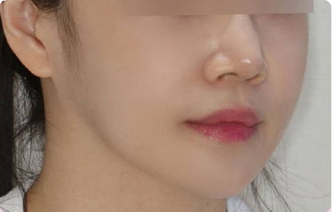 MACS 수술 전후사진