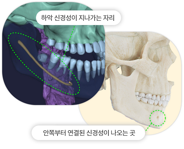 브이라인 수술!
